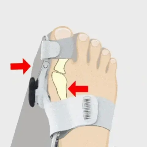 FeetiFix OrtoFlex korektor